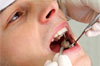 dental_amalgam.jpg